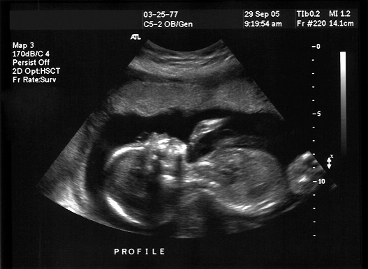 Matić Report: Abortion as a Human Right?